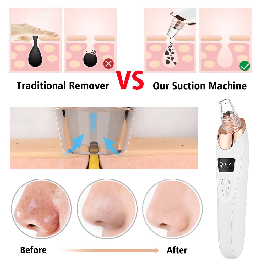 3-Mode Blackhead Remover – Face Vacuum & Dead Skin Cleansing Beauty Machine
