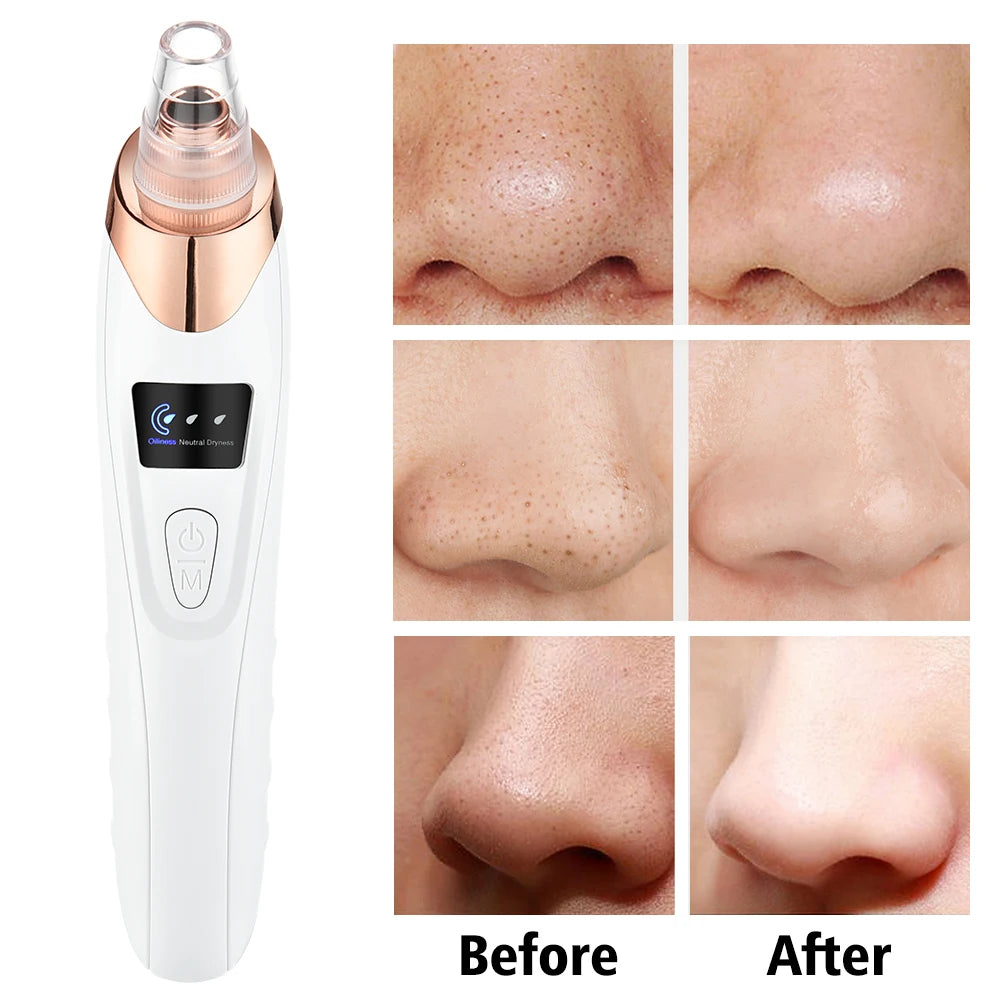3-Mode Blackhead Remover – Face Vacuum & Dead Skin Cleansing Beauty Machine